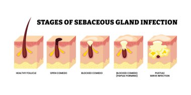 Yağlı bez enfeksiyonunun aşamaları gelişim sürecini aşamalar. Etiketlenmiş sağlıklı folikül, açık komedi kabarcığı, şiddetli enfeksiyon. Sivilce oluşumu. Tıp bilimi eğitimsel illüstrasyon