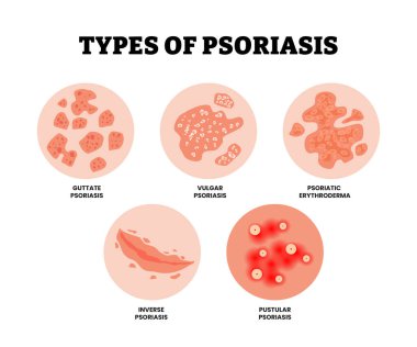 Sedef hastalığının farklı türleri. Etiketlenmiş gutat, kaba, ters, sivilceli sedef hastalığı ve sedef hastalığı. Dermatoloji alerjisi, tıbbi kaşıntı ve kızarıklık, üst derinin belirtileri..