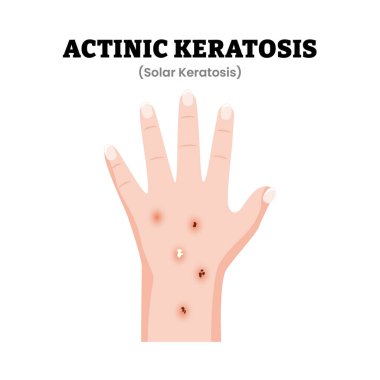 Aktinik Keratoz veya Güneş Keratozu El Belirtileri Tıbbi İllüzyonu. Güneşe maruz kalmaktan kaynaklanan pullu deri lezyonları görülüyor. Dermatoloji. Kanser öncesi cilt durumu. Düz vektör illüstrasyonu.