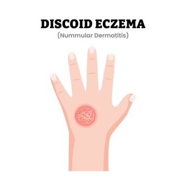 Diskoid Egzama veya Nummular Dermatit El Hastalığı Semptomları Tıbbi İllüzyon. Dairesel iltihaplı deri bantları görünüyor. Dermatoloji. Kronik iltihaplı deri hastalığı. Düz vektör illüstrasyonu.