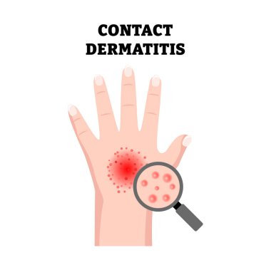Dermatit El Derisi Durumu Belirtileri Tıbbi İllüzyon 'a başvurun. Cilt kızarıklığı ve büyüteçle oluşan alerji kaynaklı tahriş. Dermatoloji. Alerjik deri reaksiyonu. Düz vektör illüstrasyonu
