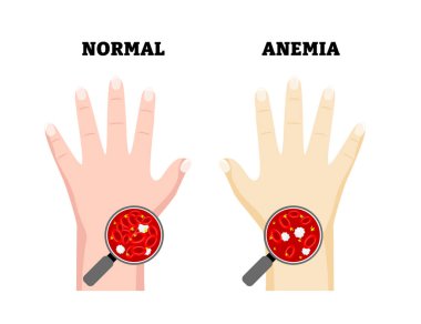 Anemi El ve Normal El Belirtileri Tıbbi İllüzyon. Kan dolaşımının azalması sonucu soluk bir deri oluşmuş. Cilt durumu. Dermatoloji. Hematoloji. Kan hastalığı. Düz vektör illüstrasyonu.
