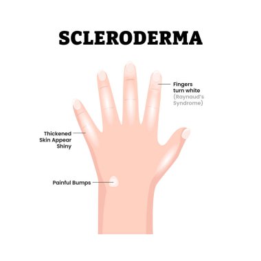 Skleroderma El Hastalığı Belirtileri Tıbbi İllüzyon. Kalın derili ve sıkılmış parmakları gösteriyor. Parmaklar beyazlaşır. Acı verici tümsekler, dermatoloji. Otoimmün hastalık. Düz vektör illüstrasyonu.