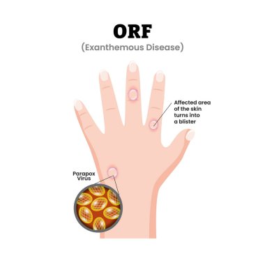 Orf Hand Enfeksiyon Semptomları veya Exanthemmpus Hastalığı Tıbbi İllüzyonu. Parmaklarında viral deri lezyonları Parapox virüsü var. Dermatoloji. Kabarcıklı derili Zoonotik viral enfeksiyon düz vektör