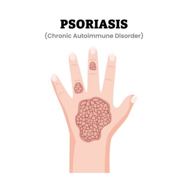 Sedef Hastalığı El Semptomları Tıbbi İllüzyon. Kalın pullu deri plakları gösteriyor. Dermatoloji. Kronik otoimmün hastalık. Düz vektör illüstrasyonu