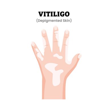 Vitiligo El Hastalığı Belirtileri Tıbbi İllüzyon. Cilt pigmentasyonunun kaybolduğunu gösteriyor. Dermatoloji. Otoimmün pigmentasyon bozukluğu. Düz vektör illüstrasyonu.