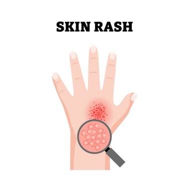Deri döküntüsü, el teması dermatit durumu, tıbbi bulgular. Yakınlaştırıcı ile kırmızı tahriş edilmiş deri yüzeyi gösteriliyor. Dermatoloji. İltihaplı deri hastalığı. Düz vektör illüstrasyonu