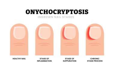 Yetişkin Ayak Tırnakları Aşaması. Onychocryptosis gelişimi. Etiketlenmiş iltihap, iltihap, kronik. Koca Ayak 'ta şişme ve Paronychia iltihabı. Sağlık hizmetleri illüstrasyonu.