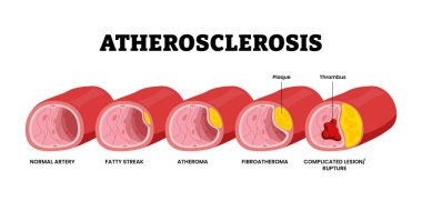 Atherosclerosis aşamaları. Koroner arter sendromu süreci. Kalp hastalığı. Etiketlenmiş normal arter, yağ damarı, atheroma, fibroatheroma, karmaşık lezyon yırtılması, plaket ve trombüs..
