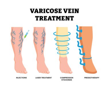 Varisli damar tedavi yöntemleri. Etiketli skleroterapi iğneleri, lazer tedavisi, sıkıştırma çorapları, pressoterapi. Şişmiş bacaklar, ayak ve bükülmüş kan damarları. Tıbbi illüstrasyon.