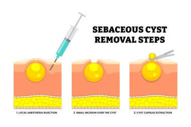 Sebaceous kist kaldırma işlemi. Lokal anestezi enjeksiyonu, kistin üzerinde küçük bir kesik, kist kapsül çıkarma. Minimum invaziv ekzisyon. Trichilemmal kist çıkarma. Cilt yapısı.