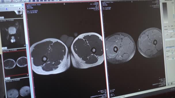 医生私人计算机对病人磁共振成像的分析 — 图库视频影像