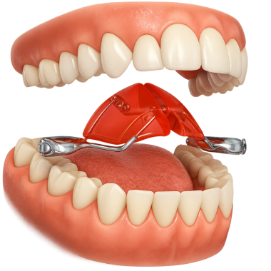 Damak açılı genişleticinin ağıza girmesi görüntüsü