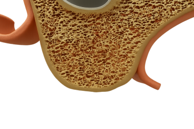 Diş implantasyonundan önce üst çene, beyaz arkaplan