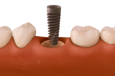 diş implantı alt çeneye yerleştiriliyor