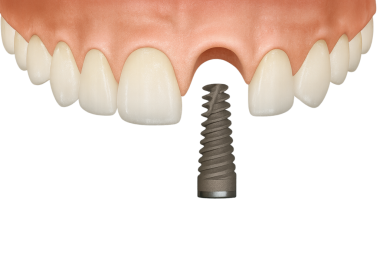 Diş implantı, ön dişi eksik.