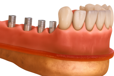 daha düşük protez destekli takma diş sistemi