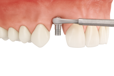 Diş implantı iyileştirme ayaklarının (iyileşme kapağı) geçici kemik nakli (geçici) abutment (geçici) nihai abutment kaplaması ile transmukozal bölümü