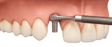 Diş implantı iyileştirme ayaklarının (iyileşme kapağı) geçici kemik nakli (geçici) abutment (geçici) nihai abutment kaplaması ile transmukozal bölümü