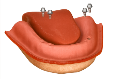 Diş implantı diş hazırlama diş kaplaması ve köprü kaplaması 
