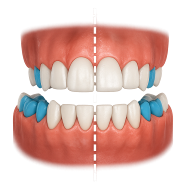 Orta hat sapması ön açık ısırıkla birleşmiş.