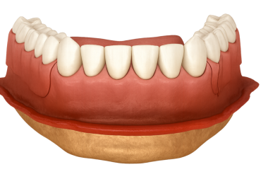 Çıkarılabilir kısmi takma diş (RPD)
