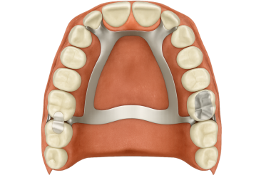 Üst dişler kısmen çıkarılabilir ön dişler Maxillary sökülebilir Kısmi Takma dişler yerine Metal Çerçeve koymak için dizayn edilmiş.