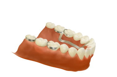 Bir döküm metal çerçeve ile çıkarılabilir kısmi takma diş (RPD)