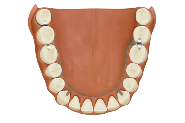 Bir döküm metal çerçeve ile çıkarılabilir kısmi takma diş (RPD)