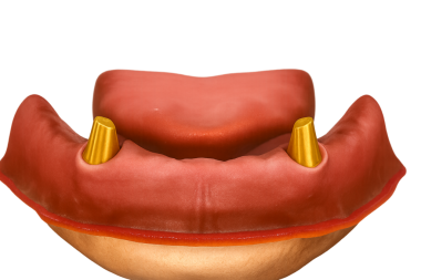 Mandibular implant yerinde iki yer belirleyici yerleştirilmiş ve yumuşak doku çevrelerine adapte edilmiş.