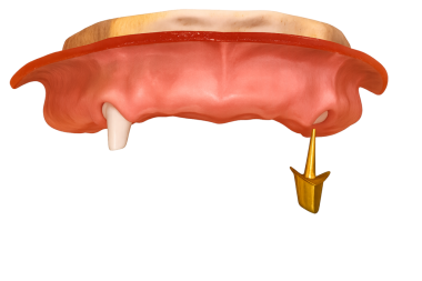 Eklenti kaldırma ya da dönüştürme eklentisi sökülürken ya da implanttan çıkarılırken protez protez takma