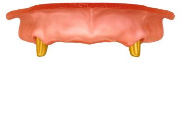 implant destekli takma dişli eklenti sistemi yer belirleyici ayraçları