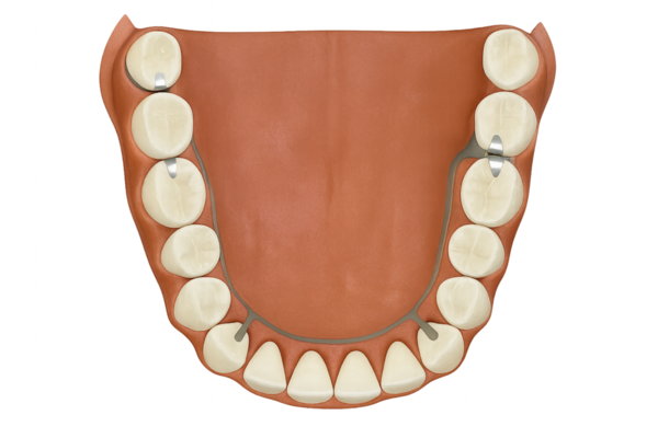 Bir döküm metal çerçeve ile çıkarılabilir kısmi takma diş (RPD)