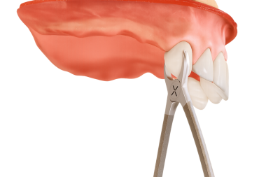 üst çene ön diş çıkarma dişleri