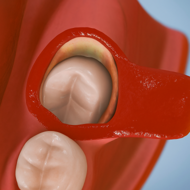 Azı dişi çıkarma dişleri