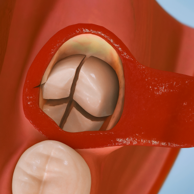 Azı dişi çıkarma dişleri