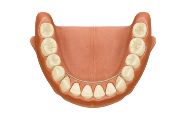 Çıkarılabilir bir takma dişden (RPD) çene kemerinin (alt çene) oklusal görünümü metal kaplamalar)