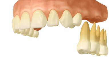 Üst ön dişler ve üst çene kemerinin arka kısmının yan (yan) görüntüsü