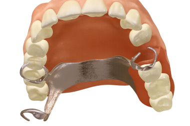 Kopyalanmış kısmi takma dişli rpd