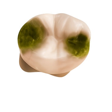 Diş çürüğü ilerleme kaydediyor.