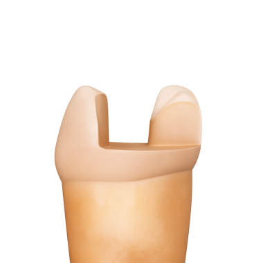 Onlay kapağı bir ya da daha fazla dişler