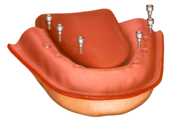 Alt çene implantı destekli takma diş sistemi