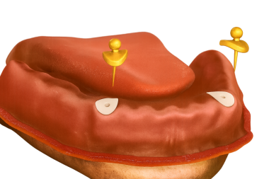 çivi (top) eklentilerini kullanarak çene implantı ile korunmuş takma dişler