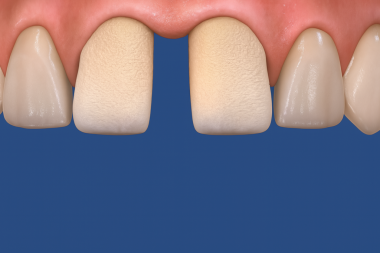 Venedikler Porselen ya da kaplama