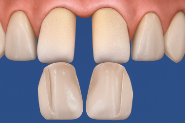 Venedikler Porselen ya da kaplama