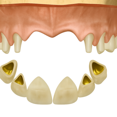 Sabit kısmi takma diş (köprü) ve hazırlanmış ayaklar