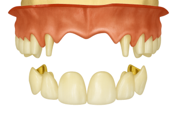 Sabit kısmi takma diş (köprü) ve hazırlanmış ayaklar