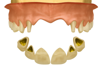 Sabit kısmi takma diş (köprü) ve hazırlanmış ayaklar