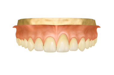 Sakız durgunluğu olan üst merkezi kesici diş.