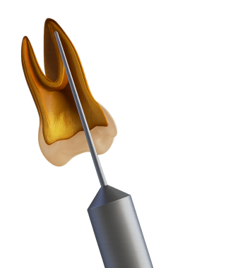 Kanal tedavisi sırasında kanal biçimlendirme / kanal oluşturma